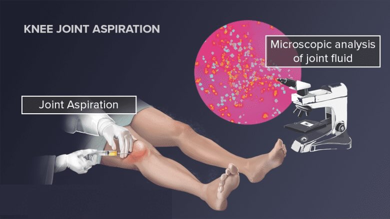 آنالیز مایع مفصلی
