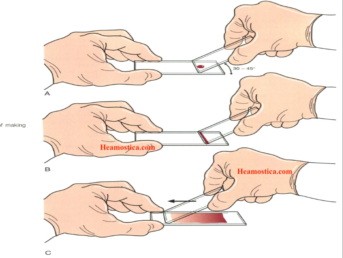 تهیه اسمیر خون محیطی