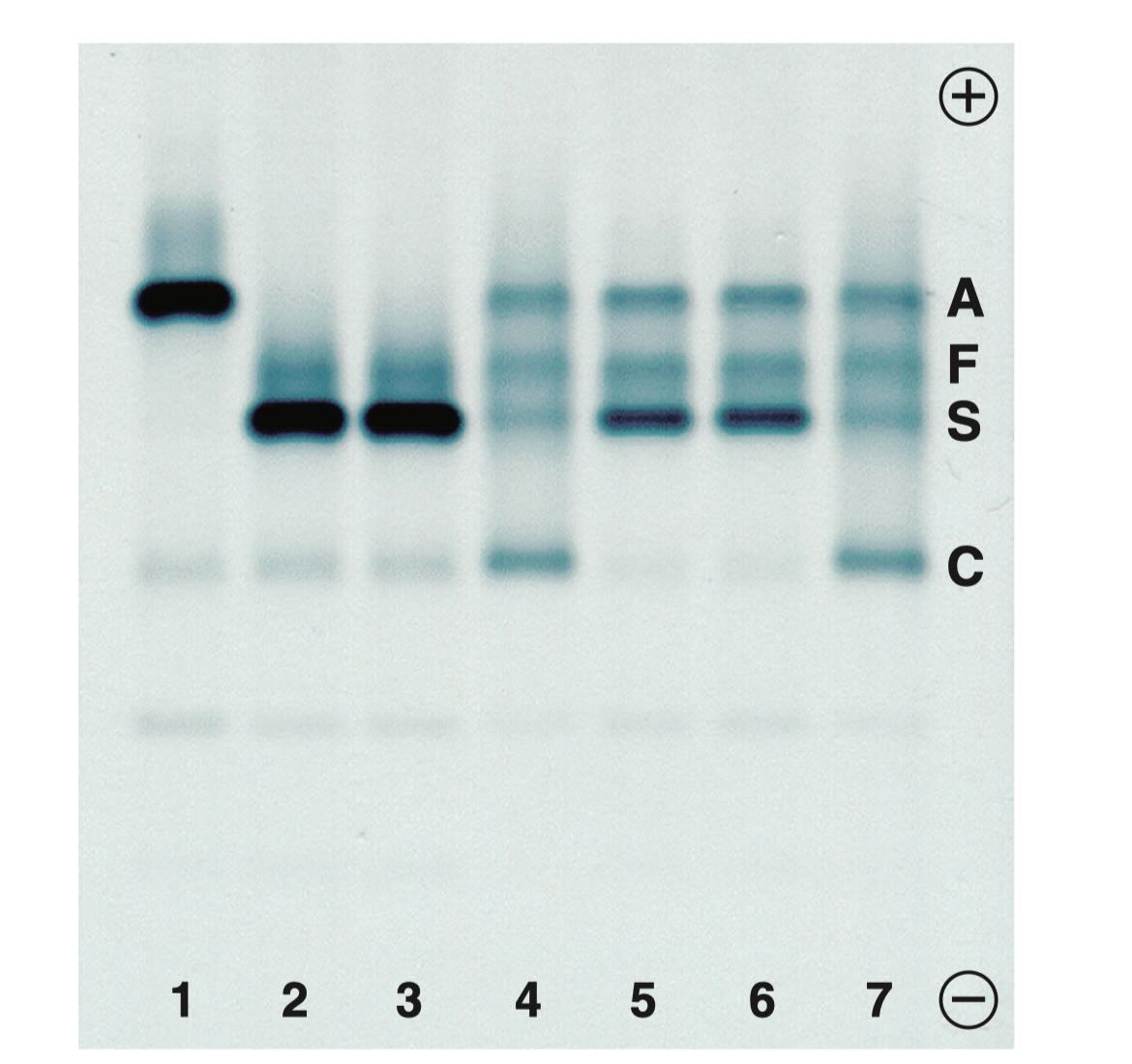 الکتروفورز هموگلوبین