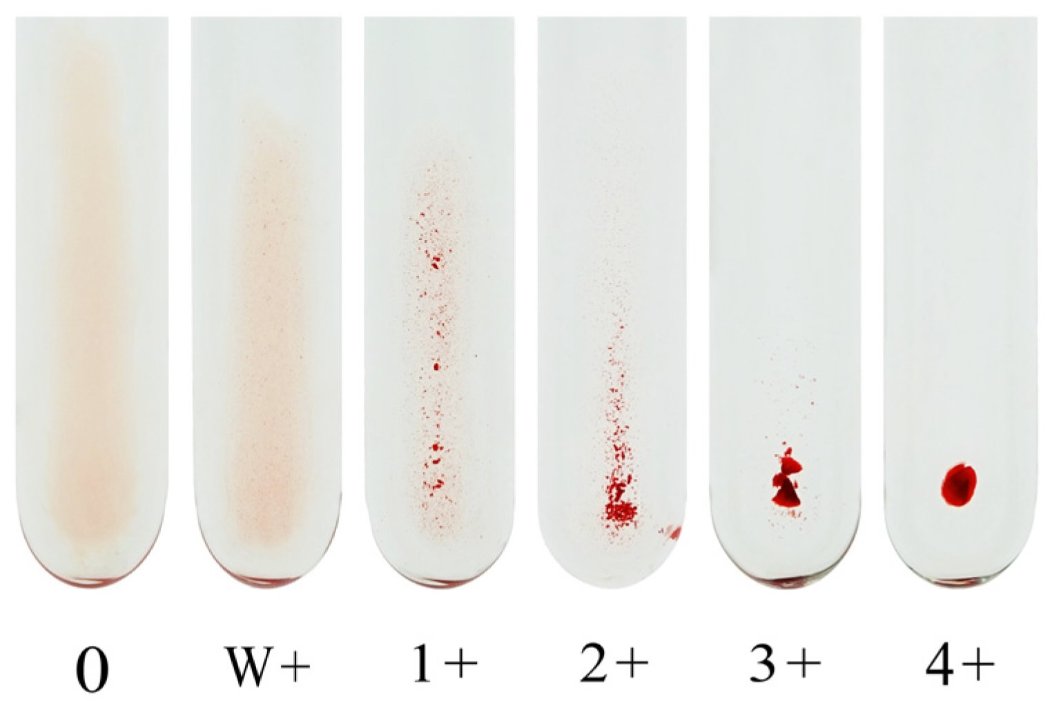 درجه بندی آگلوتیناسیون