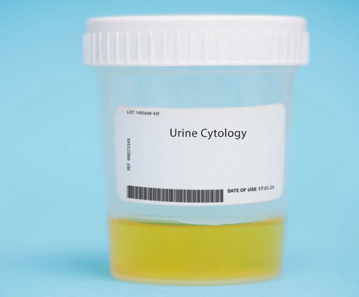 روش انجام آزمایش سیتولوژی ادرار
