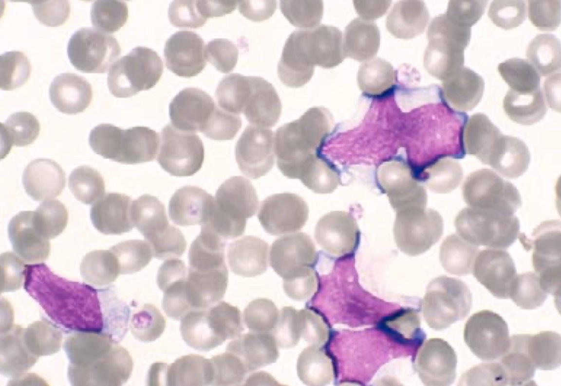 لنفوسیت آتیپیک در عفونت ویروسی