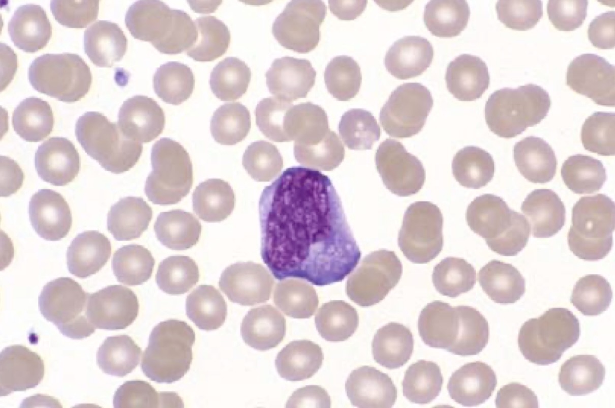 لنفوسیت ری اکتیو در مونونوکلئوز عفونی