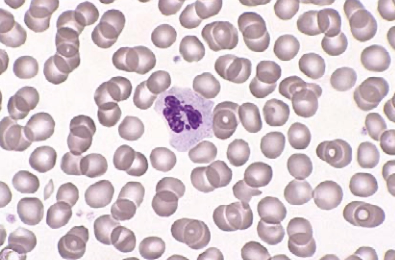 آموزش دیف هماتولوژی