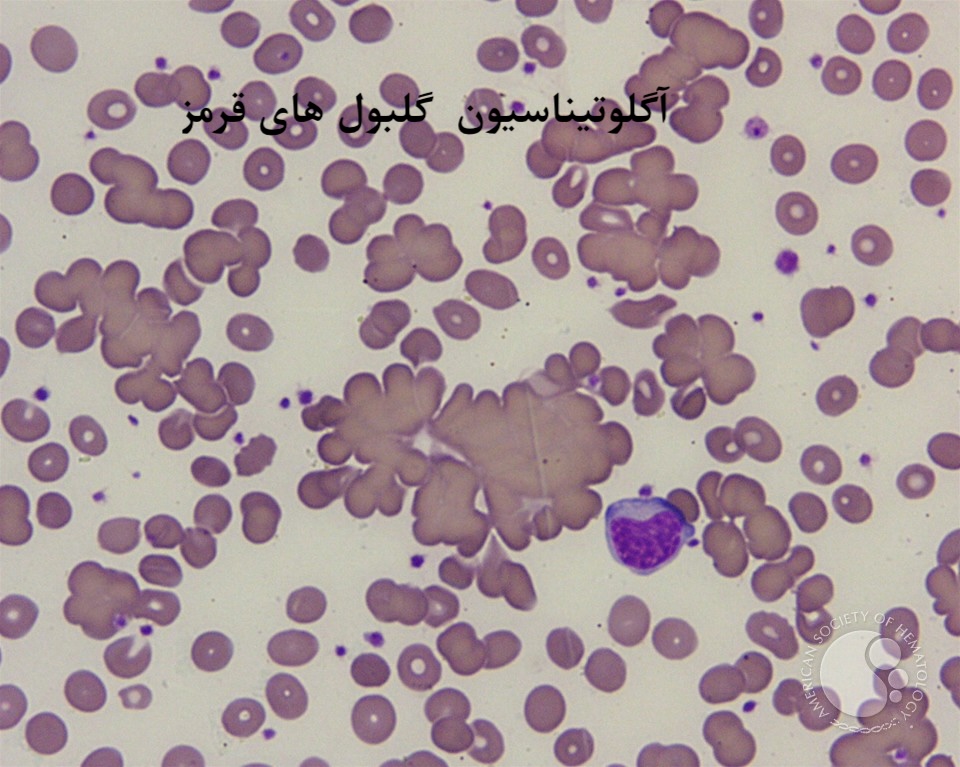 افتراق رولو از آگلوتیناسیون