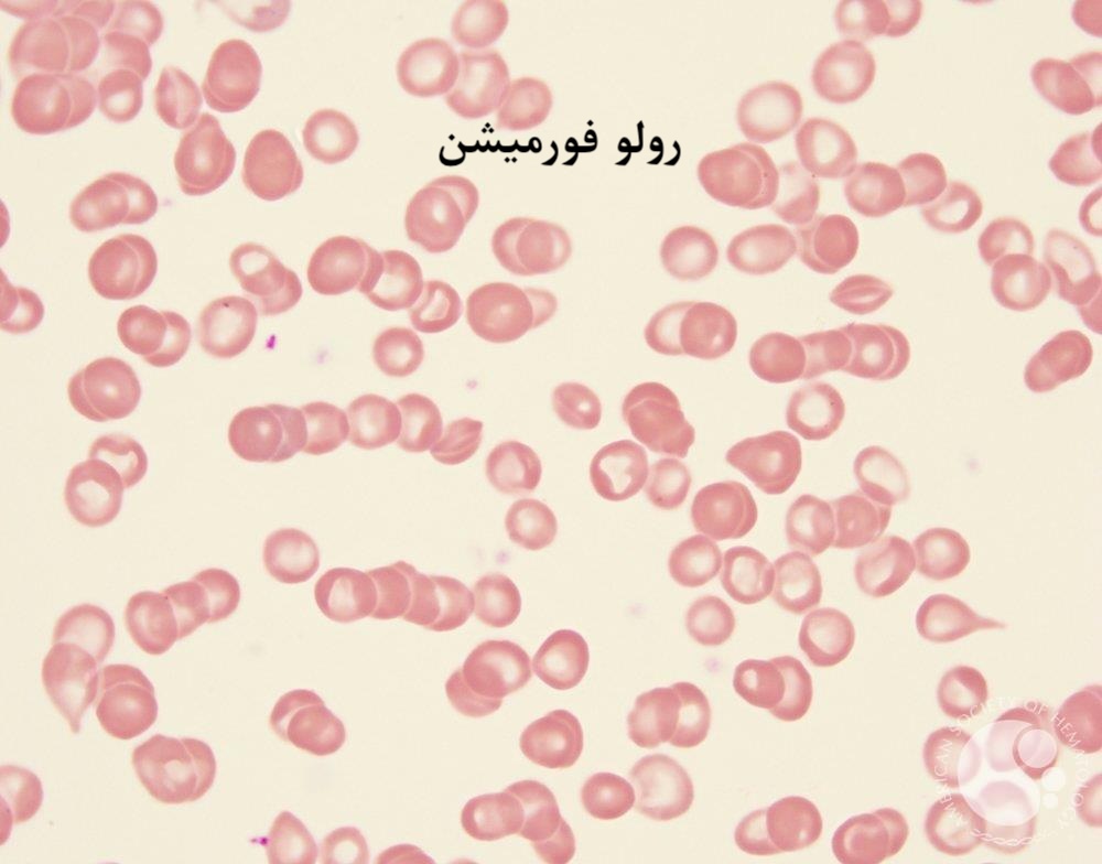 افتراق رولو از آگلوتیناسیون